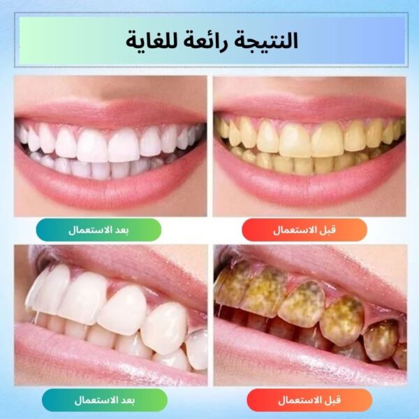 قلم جل تبييض الأسنان - نتائج ملحوضة بعد كل استعمال - Image 2